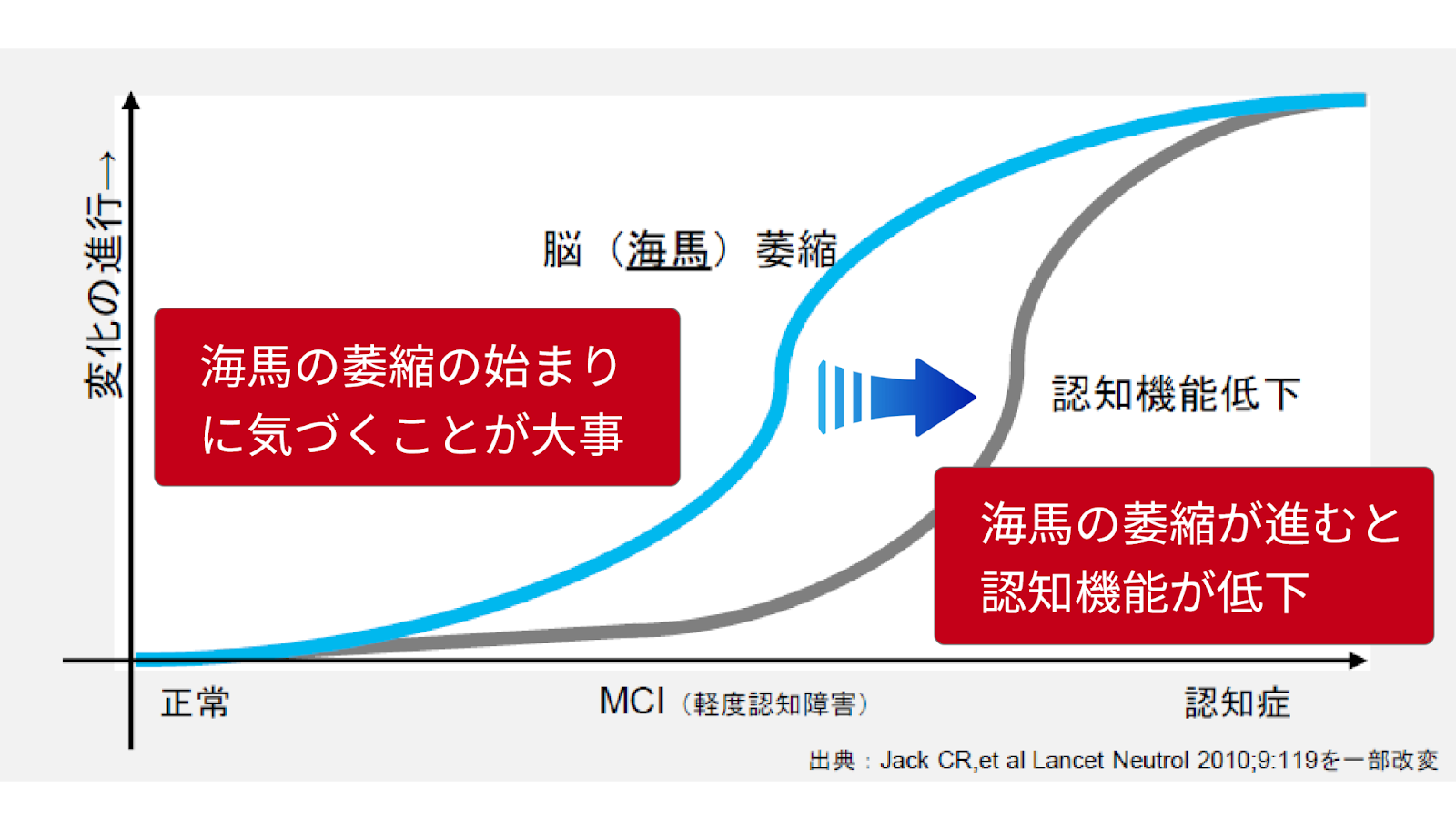 海馬の萎縮比較